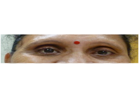 Eye Surgery in Ahmedabad