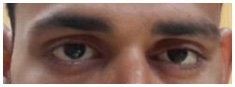 Oculoplasty Surgeon in Ahmedabad, Laser Eye Surgery Cost in Ahmedabad, Eye Number Removal Operation in Ahmedabad